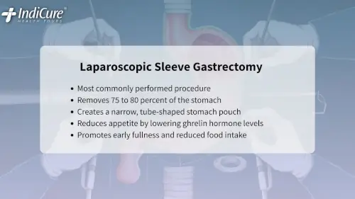 Infographic explaining how Laparoscopic Sleeve Gastrectomy works by removing 75-80% of the stomach and lowering ghrelin levels for weight loss.